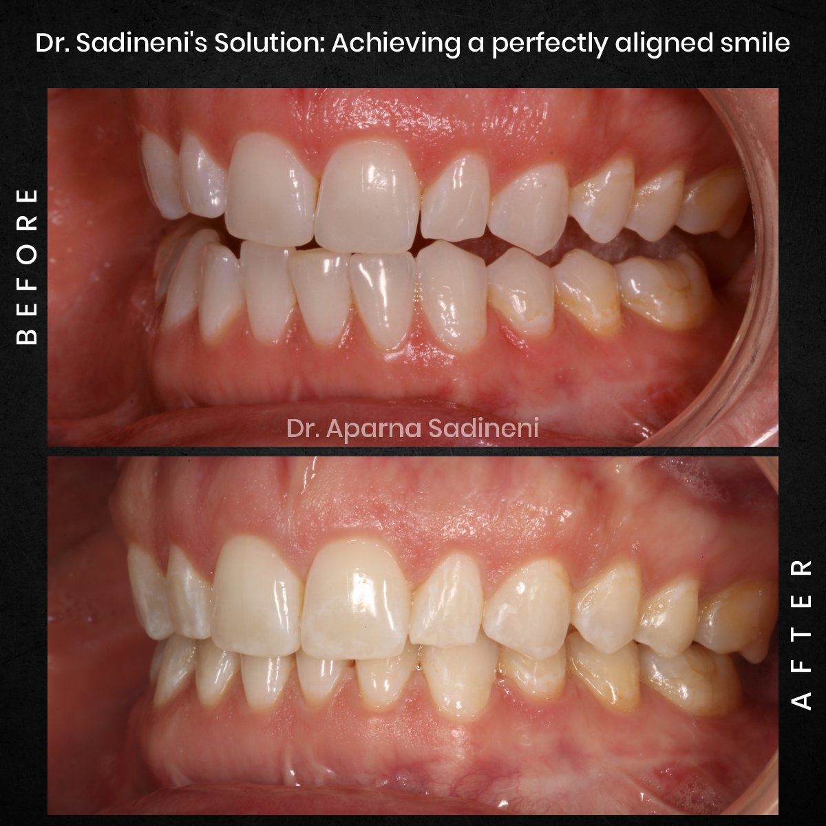 DMD DEC GRID 1 POST 1 TEETH B&A - ALICIA_3 (1)