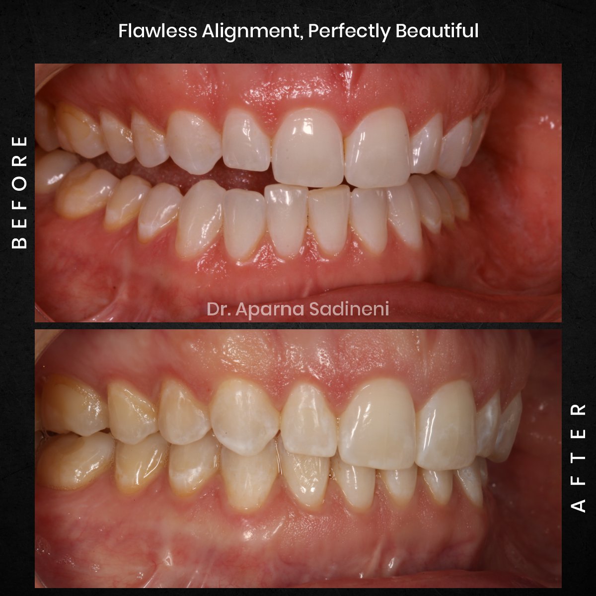 DMD DEC GRID 1 POST 1 TEETH B&A - ALICIA_4