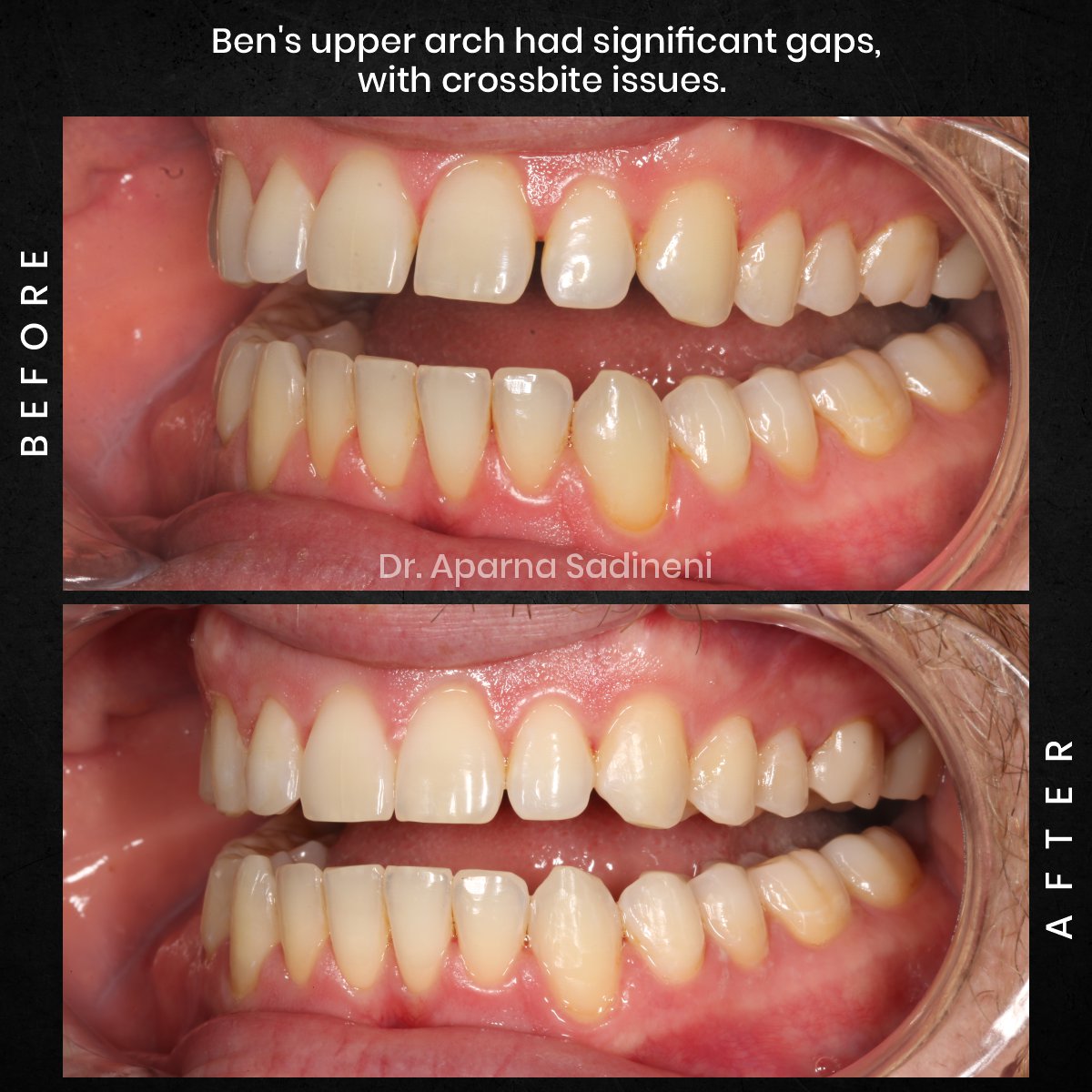 DMD OCT GRID 2 POST 3 TEETH B&A - BEN C_1